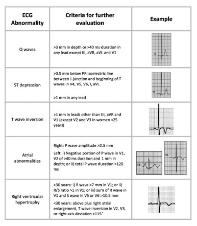 ECG chart
