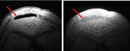 ‘No pain, no gain’. The best way to train? Erasmus MC study project evaluates two different exercise therapies for patellar tendinopathy in a RCT with the innovative 3D Ultrashort echo time (UTE)-MRI technique