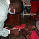 buruli_ulcer