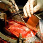 kidney_donation