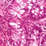 inflammatory_bowel