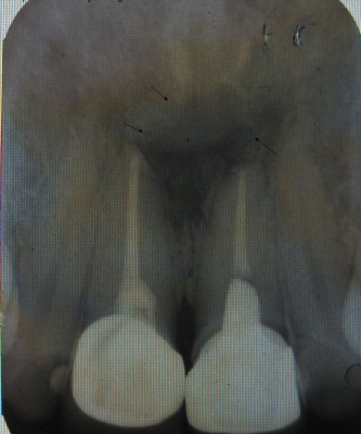 Postoperative_radiograph_Figure_3 (1)
