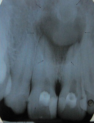 Preoperative_radiograph_Figure_1 (1)