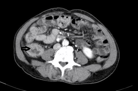 Figure_1-CT_abdomen_showing_irregular_wall_thickening_of_the_caecum.