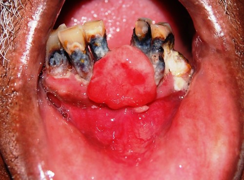 Figure_1-_Exophytic_growth_in_the_mandibular_anterior_region_crossing_midline-_Labial_view.