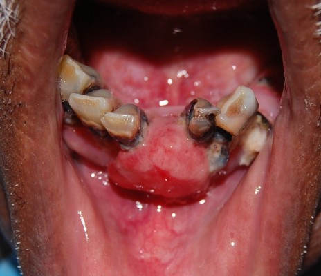 Figure_2-_Mesio-distal_and_Labio-lingual_extension_of_growth.
