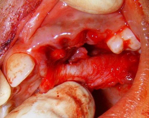 figure_4-Intraoral_Perioperative_view