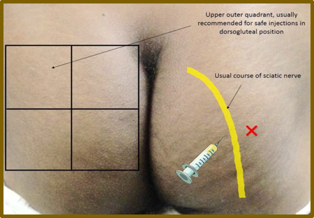 Picture1-injection