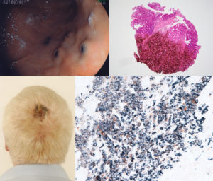 Melanoma_stitched